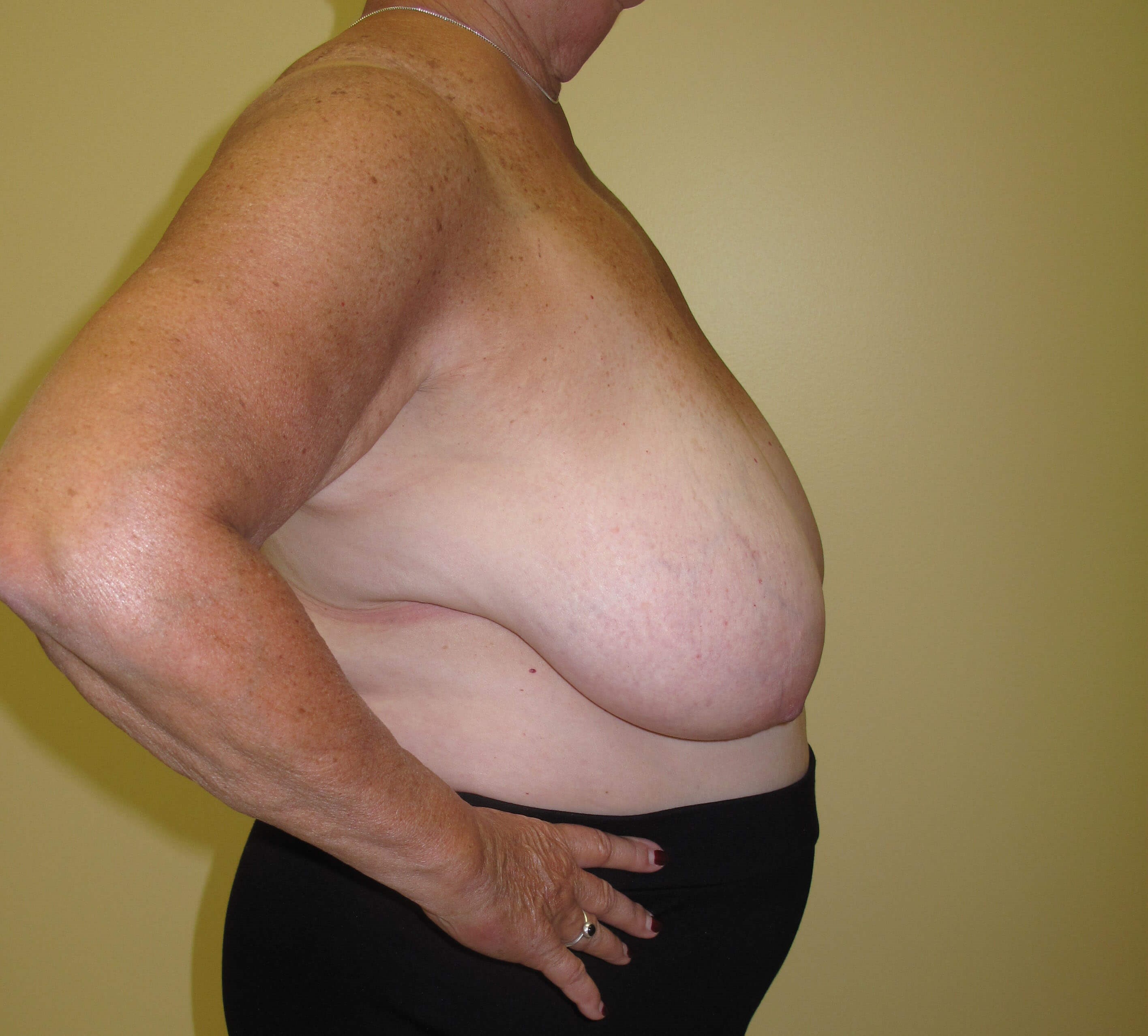 Breast Reduction Before (Side View)