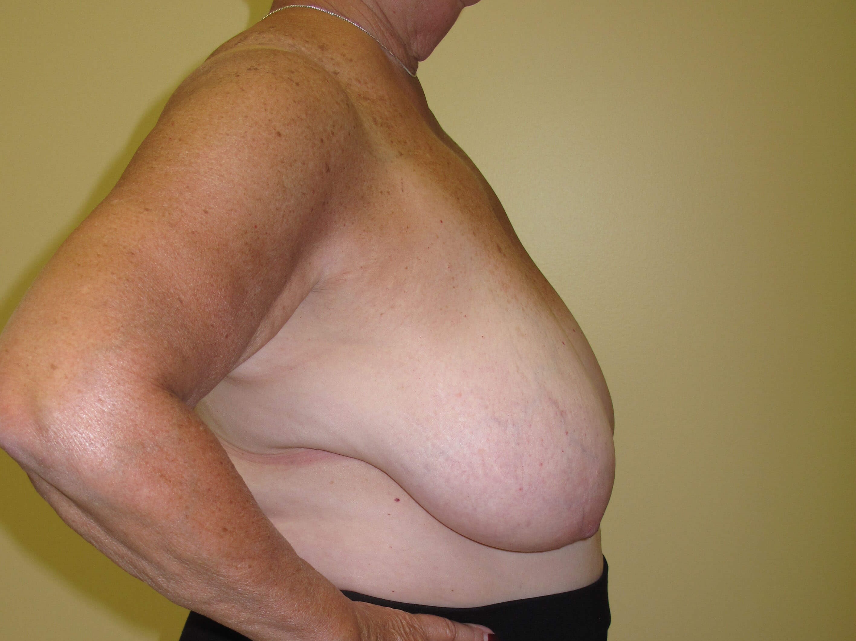 Breast Reduction Before (Side View)