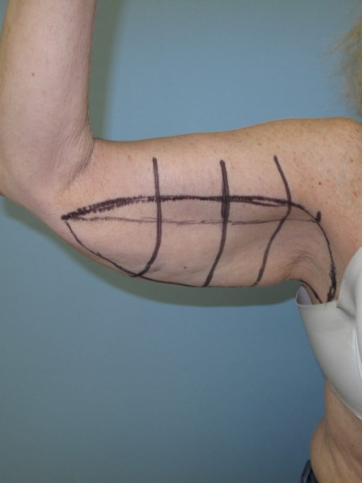 Arm Lift - brachioplasty Before