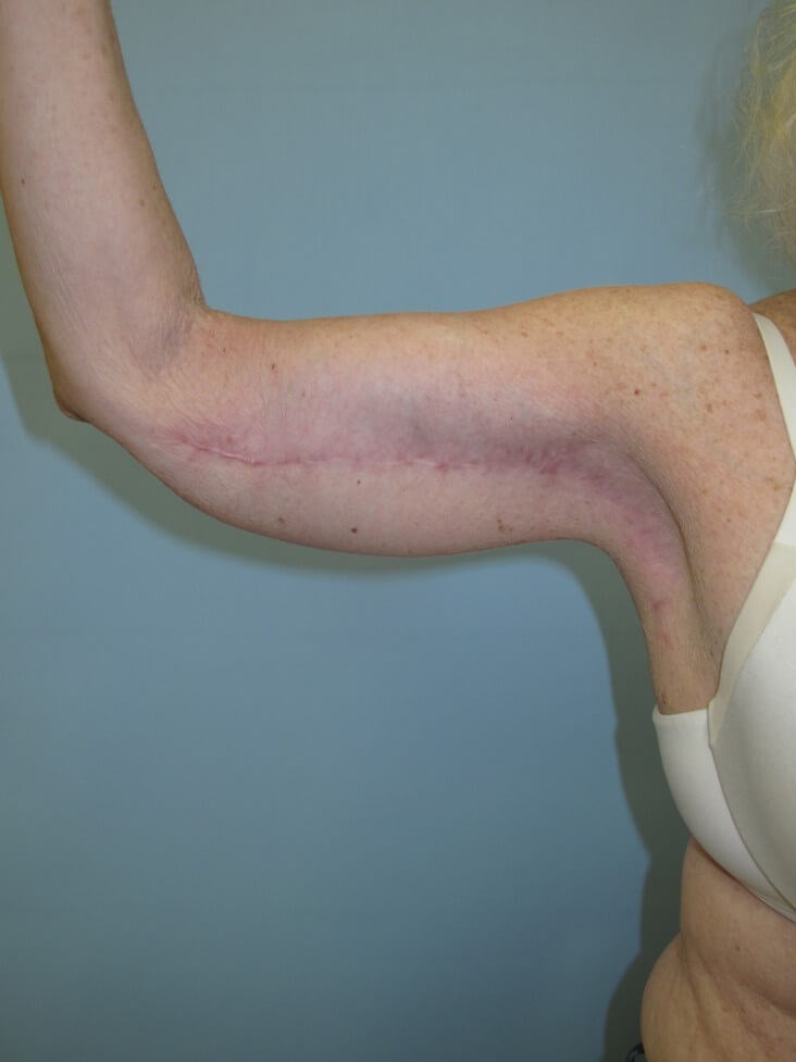 Arm Lift - brachioplasty After