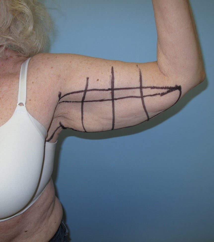 Arm Lift - brachioplasty Before