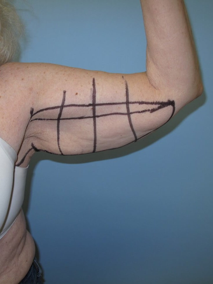 Arm Lift - brachioplasty Before