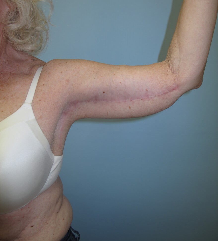 Arm Lift - brachioplasty After