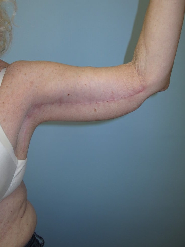 Arm Lift - brachioplasty After