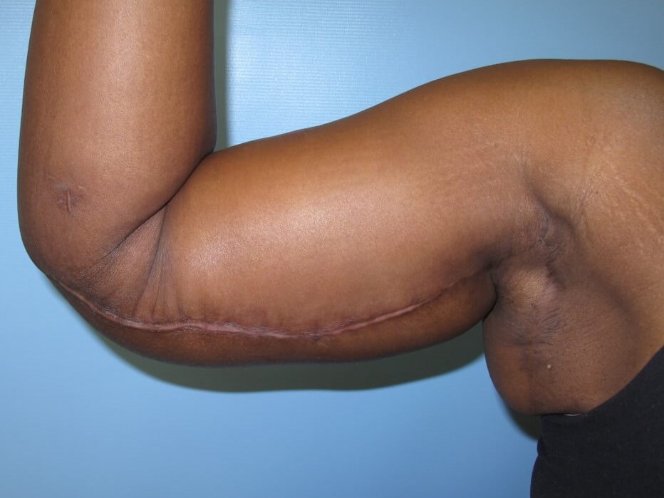 Arm Lift After