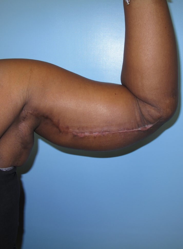 Arm Lift After
