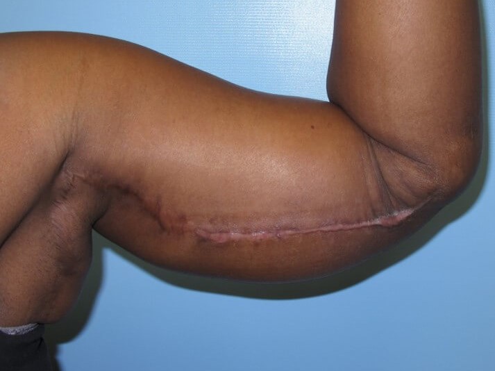 Arm Lift After