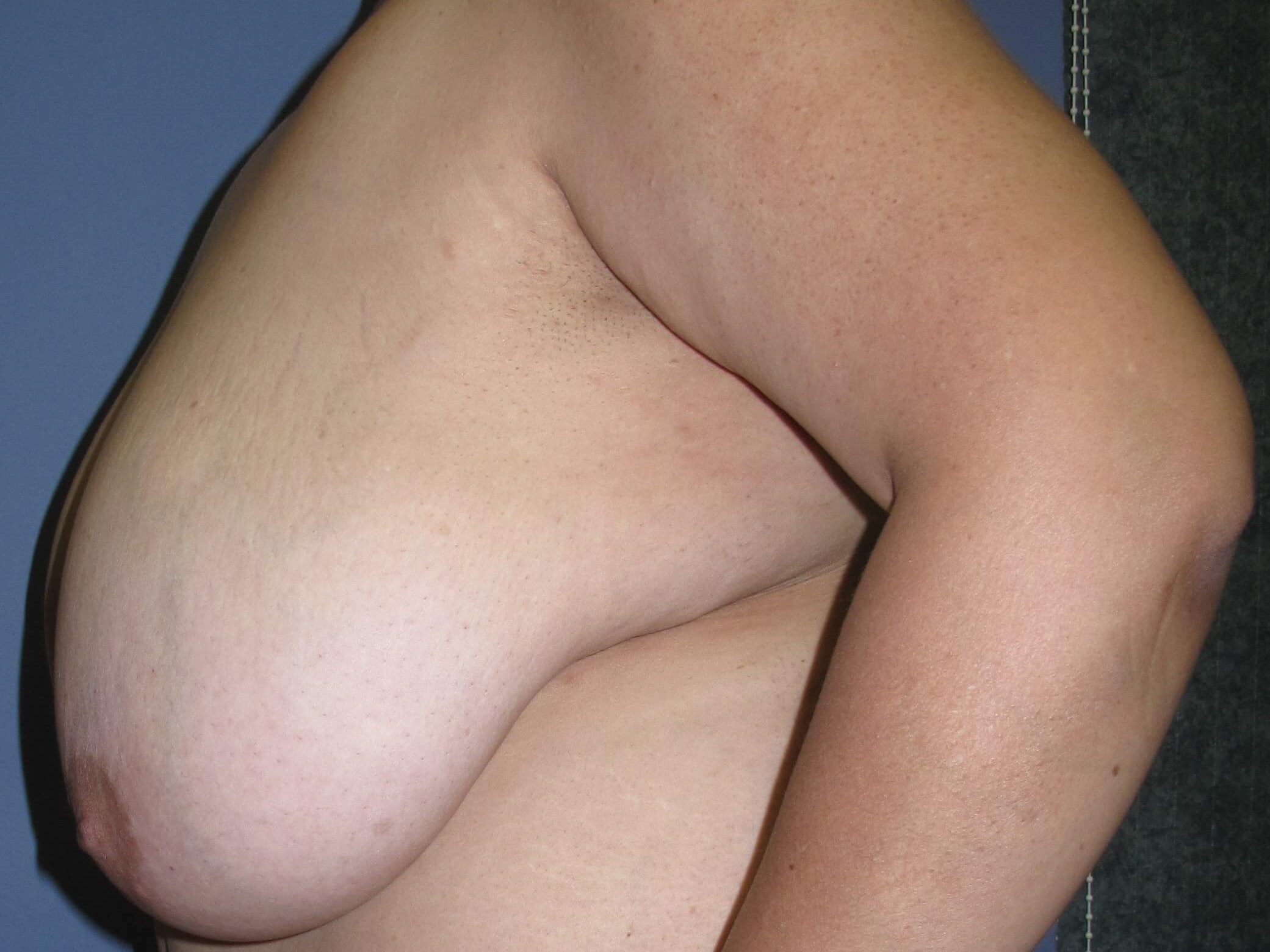 Breast Reduction Before (Side View)