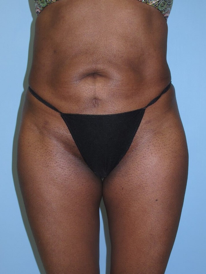Liposuction After (Front)