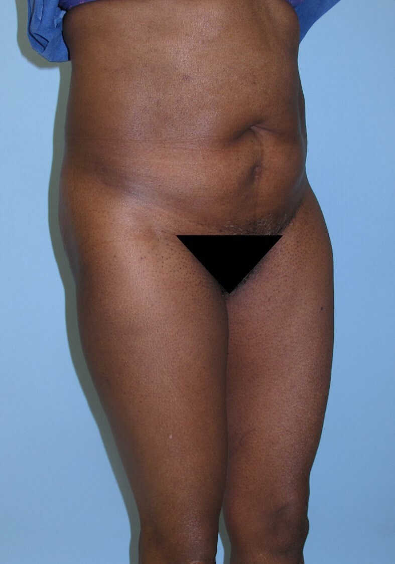 Liposuction Before (Oblique View)