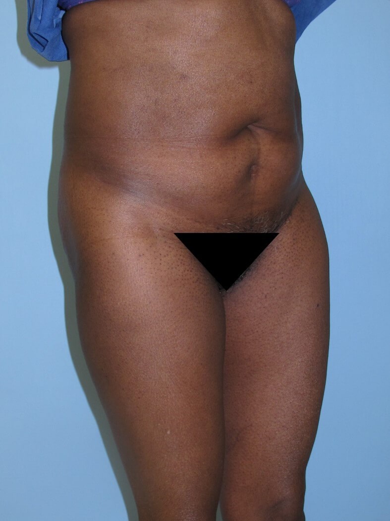 Liposuction Before (Oblique View)