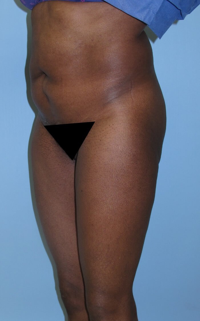 Liposuction Before (Oblique View)