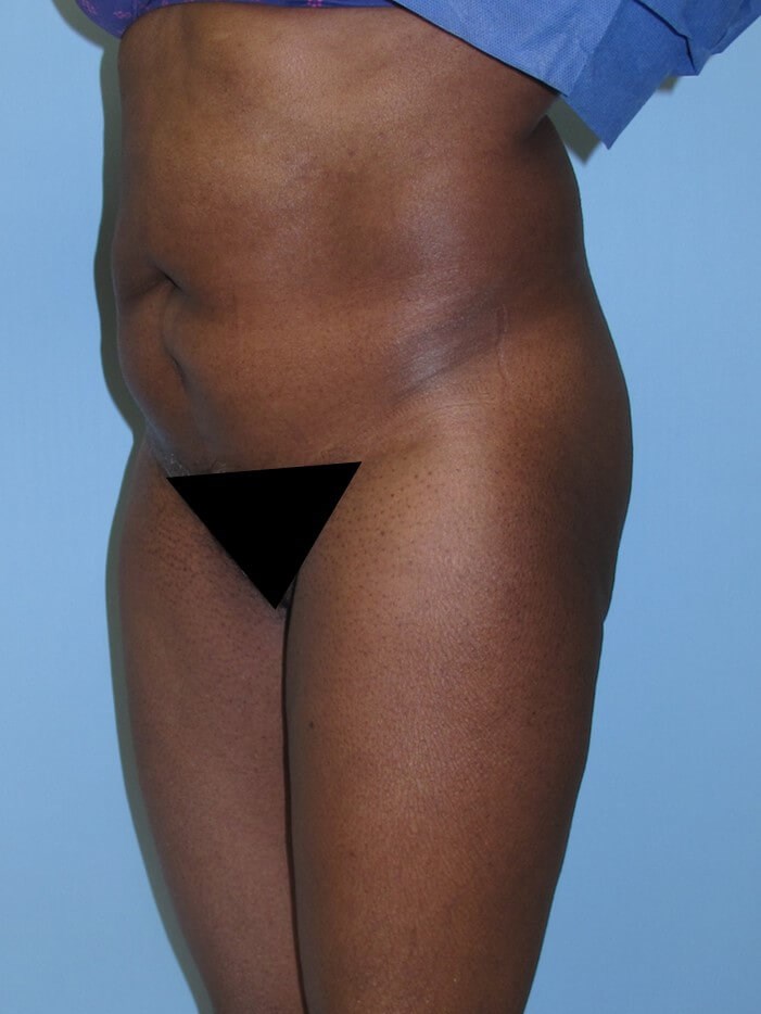 Liposuction Before (Oblique View)