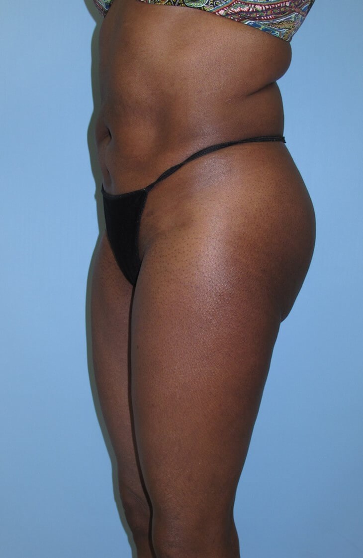 Liposuction After (Oblique View)
