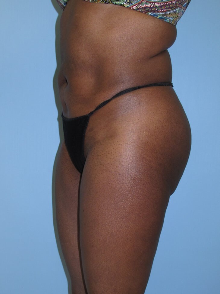 Liposuction After (Oblique View)