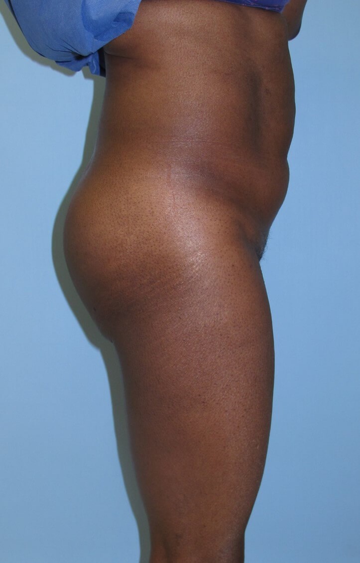 Liposuction Before (Side View)