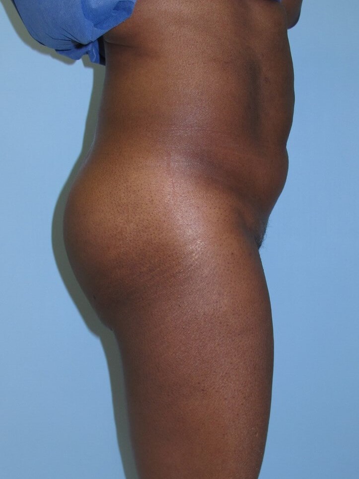 Liposuction Before (Side View)