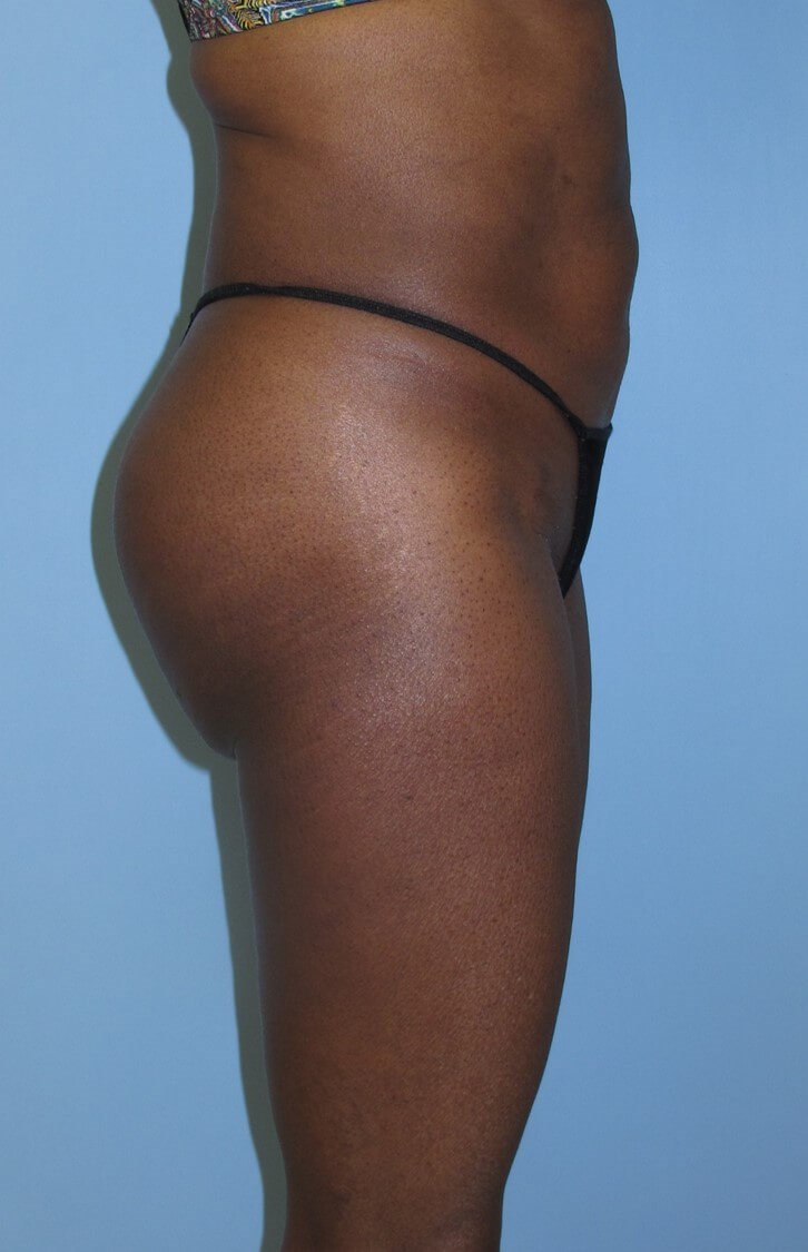 Liposuction After (Side View)