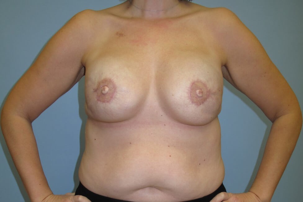 Breast Reconstruction After