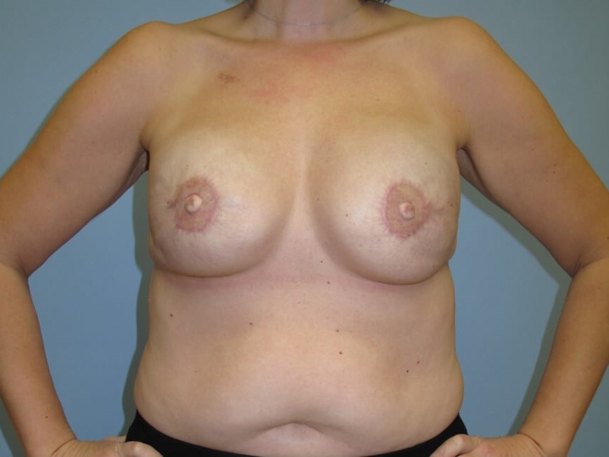 Breast Reconstruction After