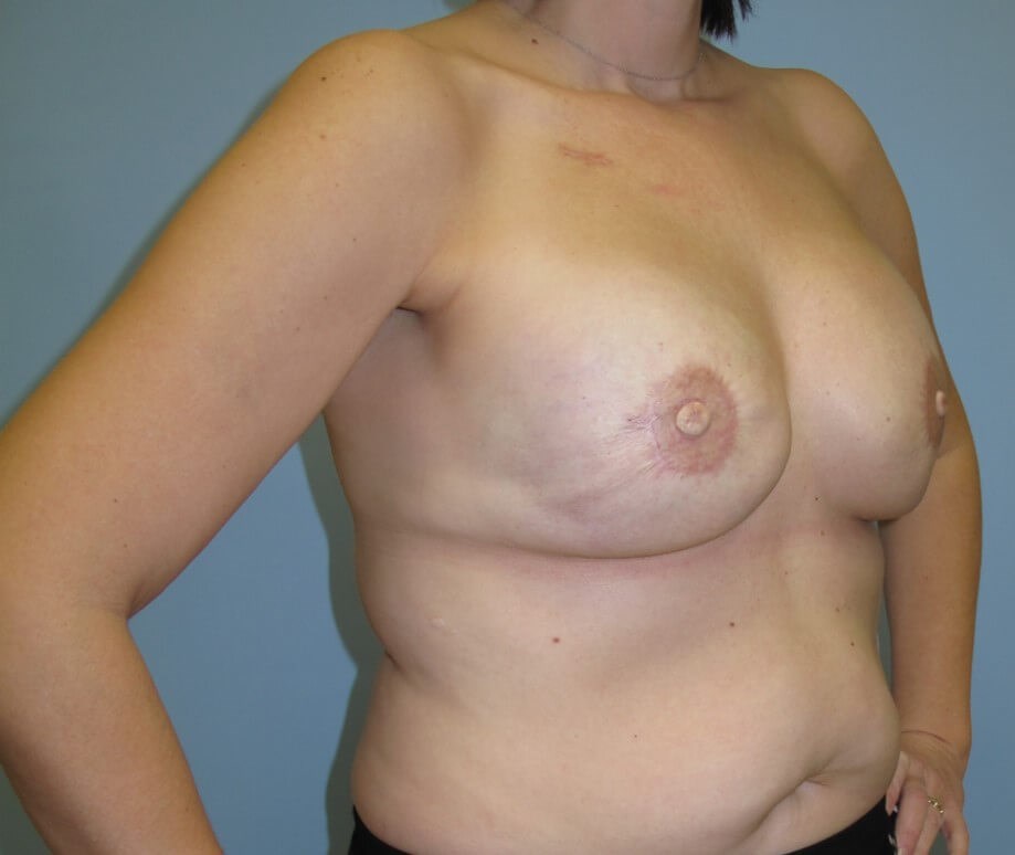 Breast Reconstruction After (Oblique View)