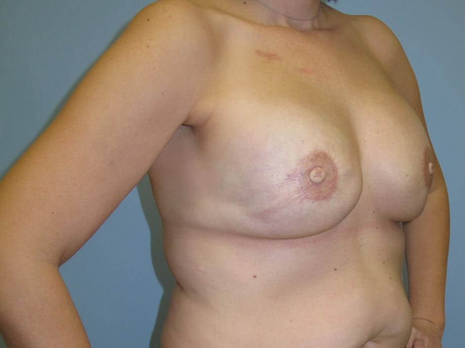 Breast Reconstruction After (Oblique View)