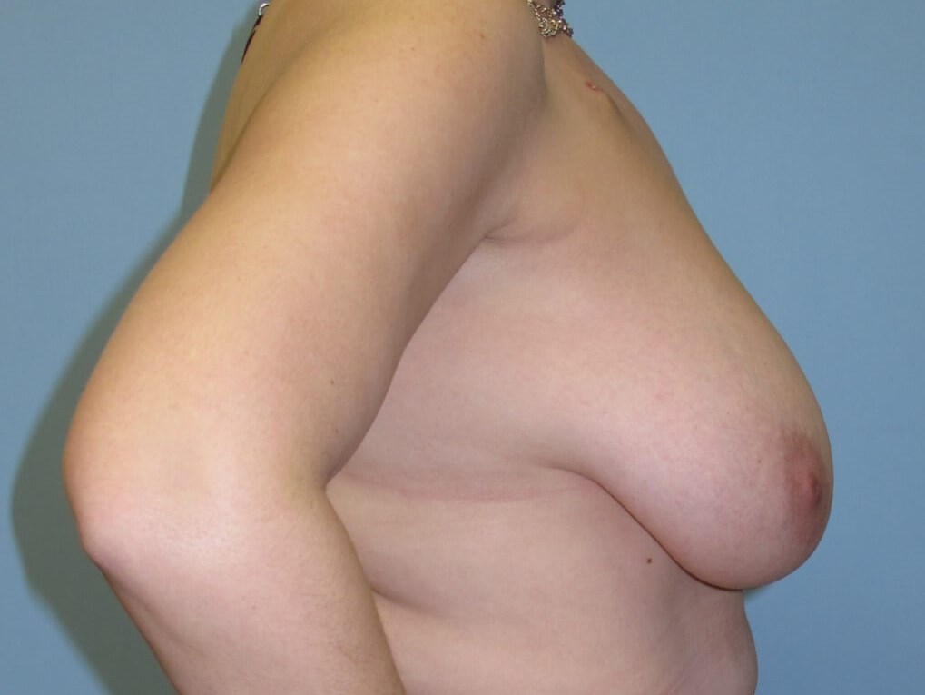Breast Reconstruction Before (Side View)