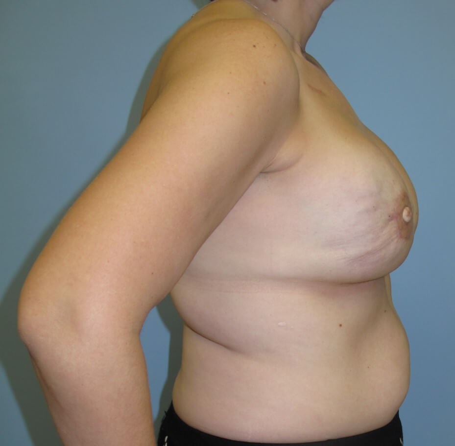 Breast Reconstruction After (Side View)
