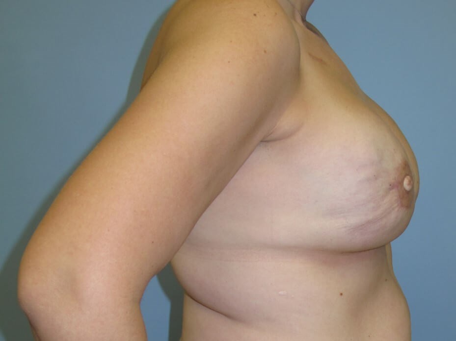 Breast Reconstruction After (Side View)