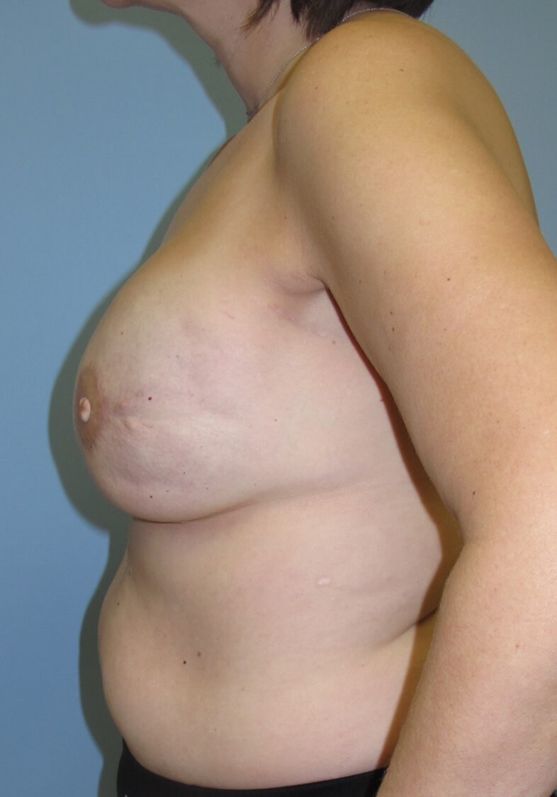Breast Reconstruction After (Side View)