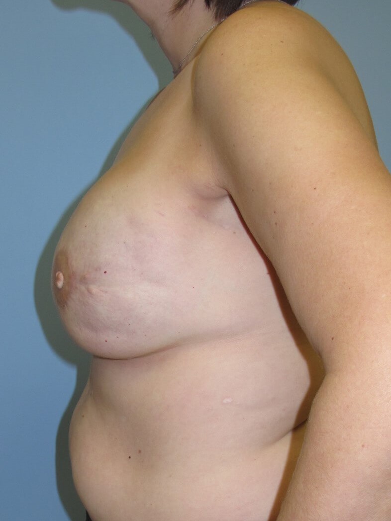 Breast Reconstruction After (Side View)