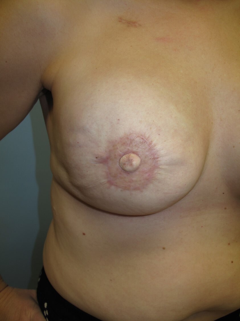 Breast Reconstruction Right Reconstructed Nipple