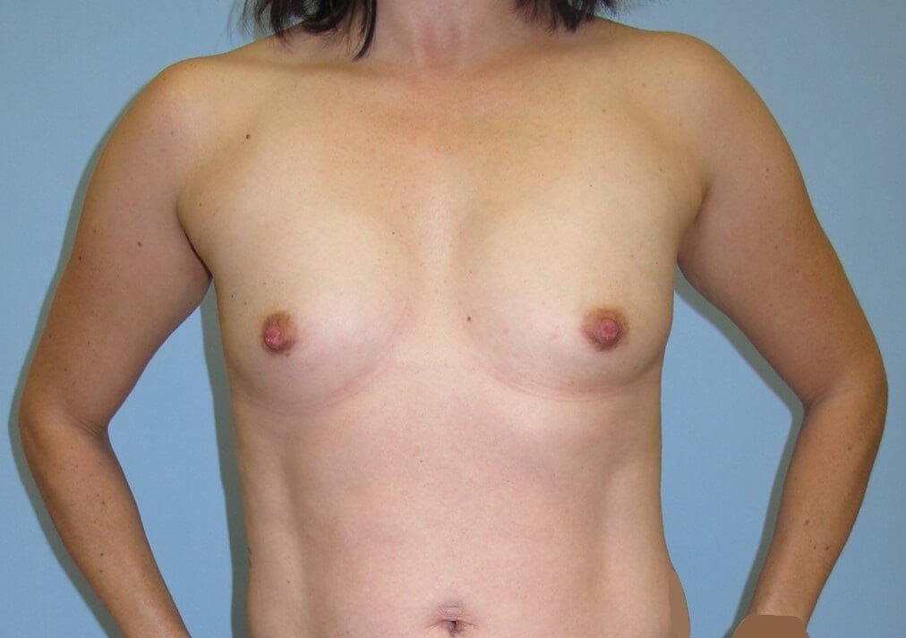 Breast Augmentation Before (Front)
