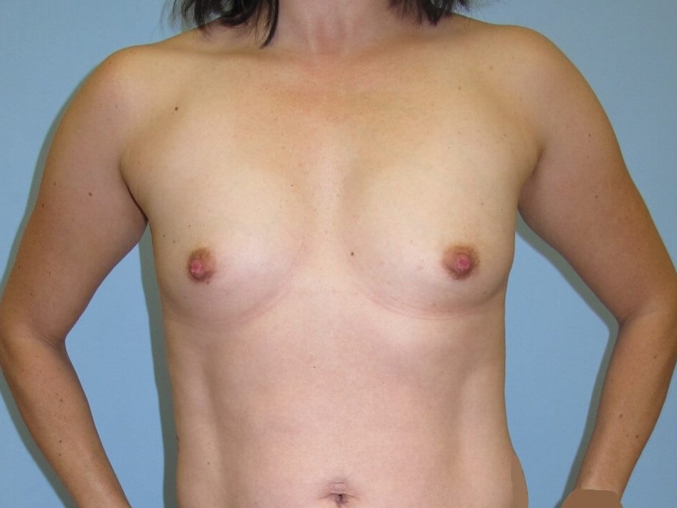 Breast Augmentation Before (Front)