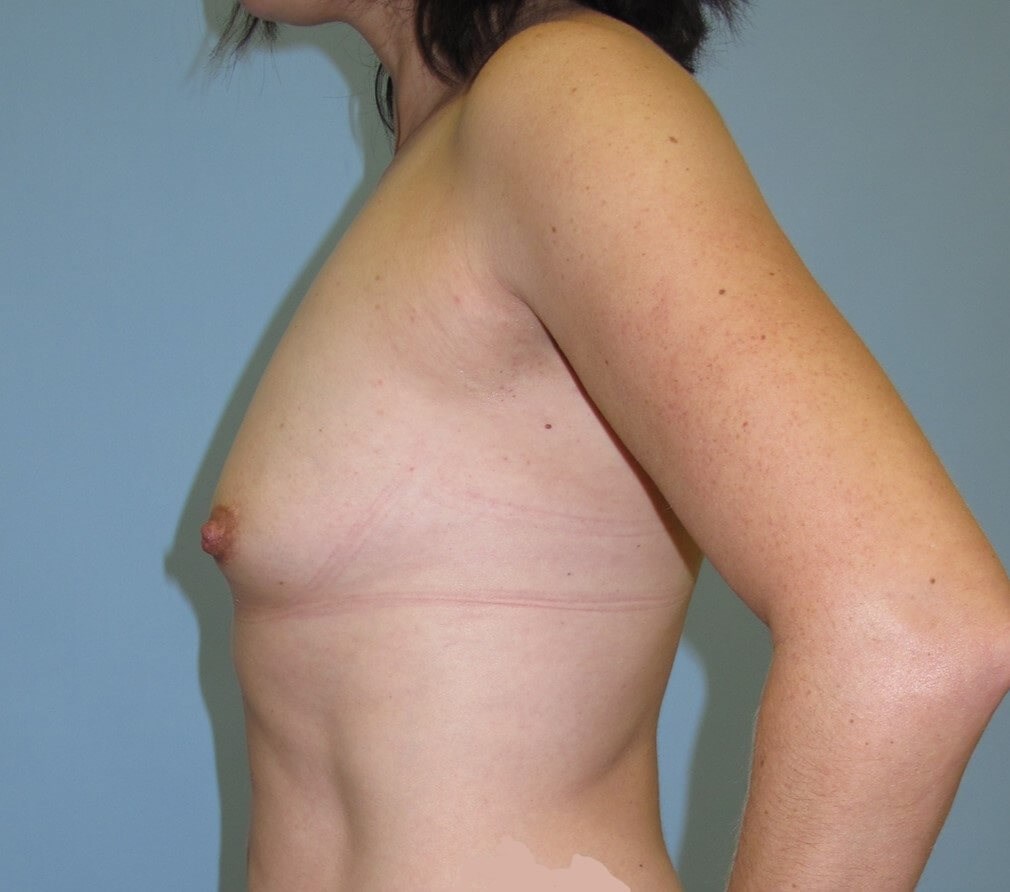 Breast Augmentation Before (Side View)