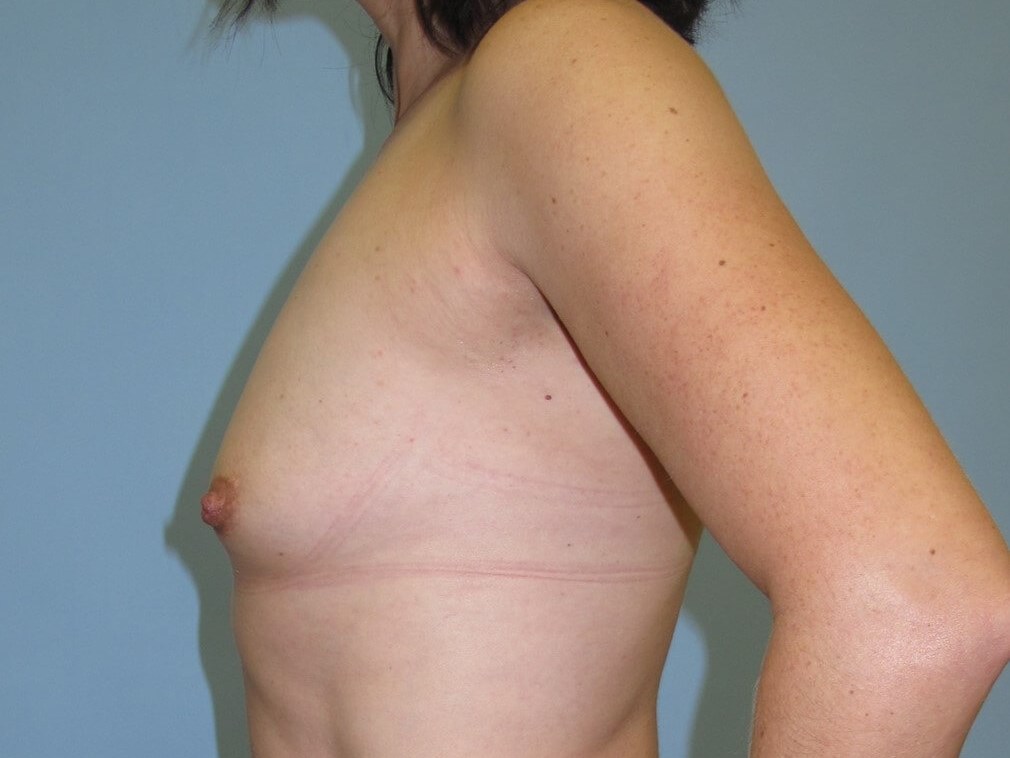 Breast Augmentation Before (Side View)