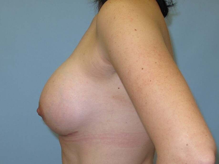 Breast Augmentation After (Side View)