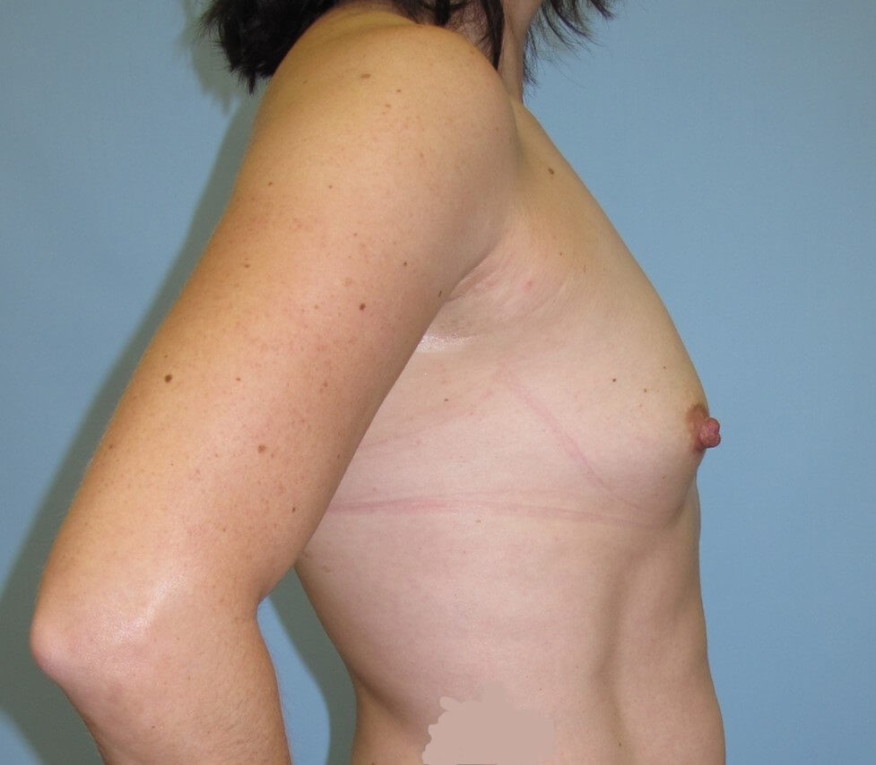 Breast Augmentation Before
