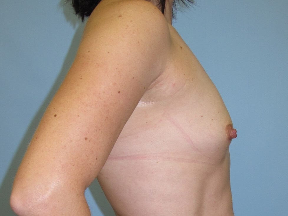 Breast Augmentation Before