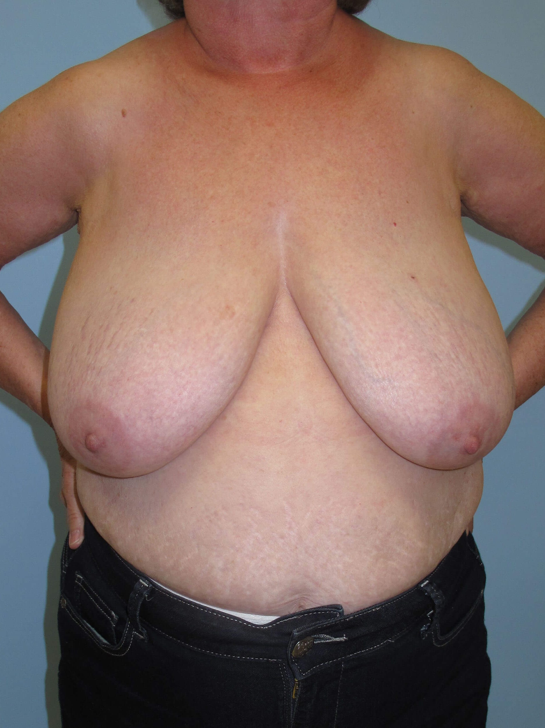 Breast Reduction Before