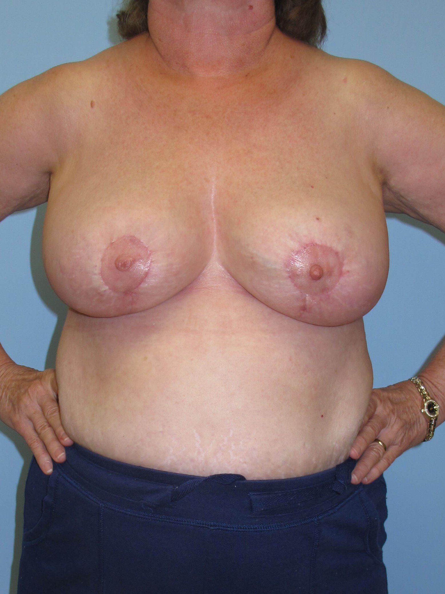 Breast Reduction After