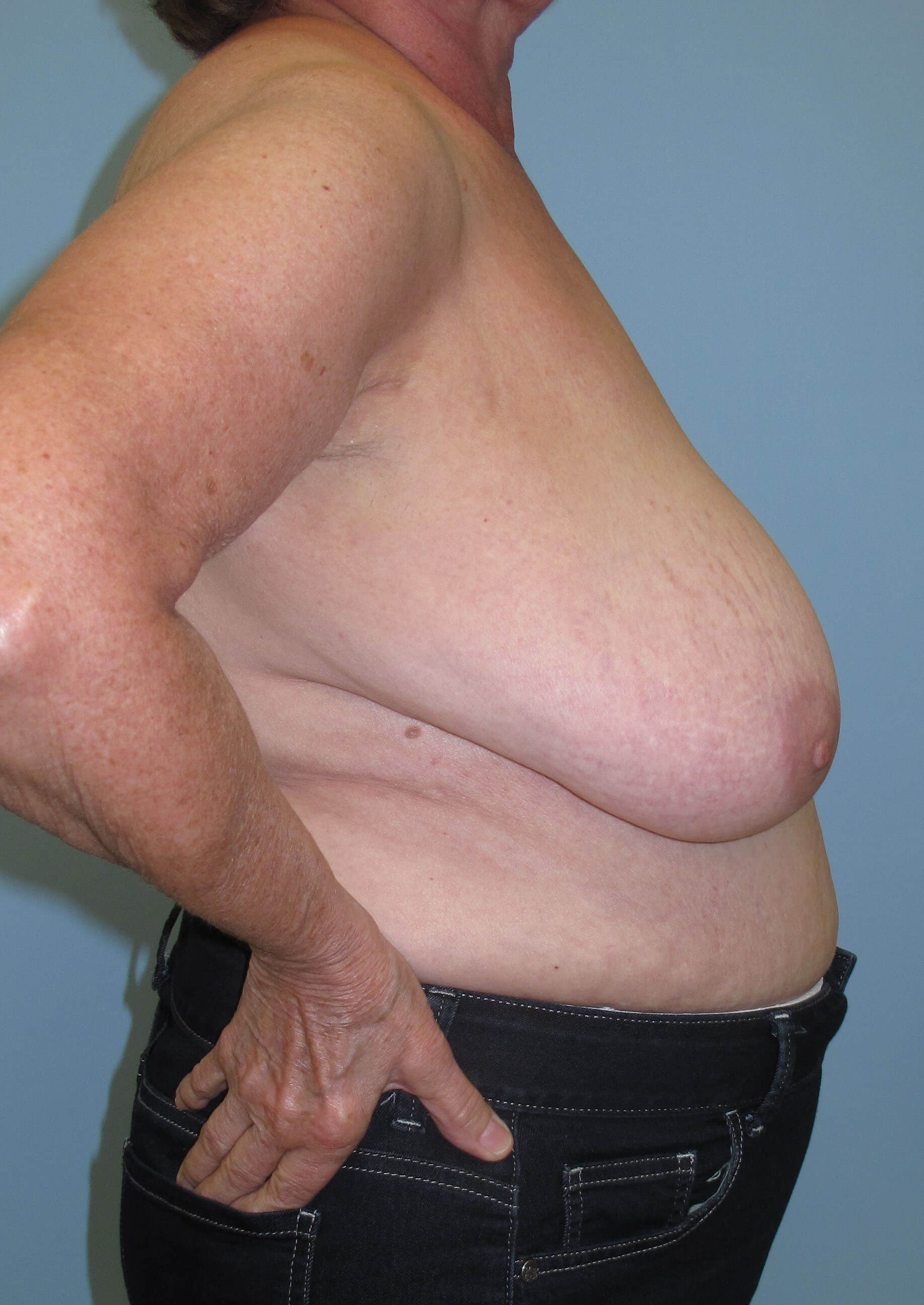 Breast Reduction Before