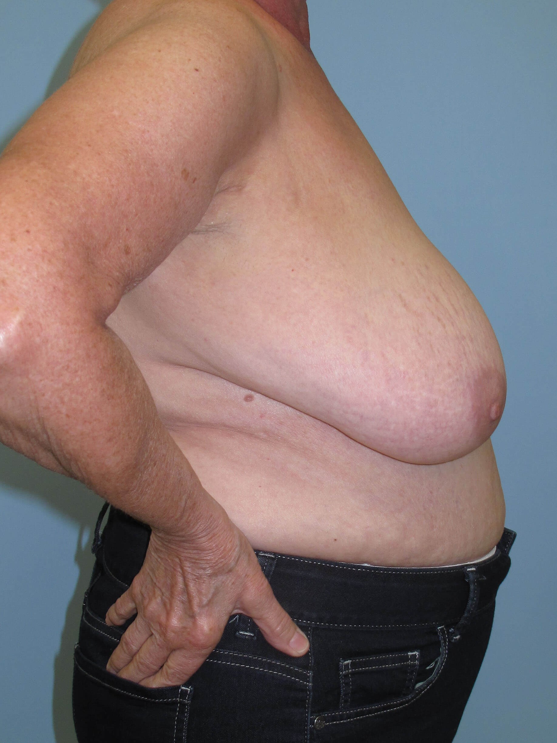 Breast Reduction Before