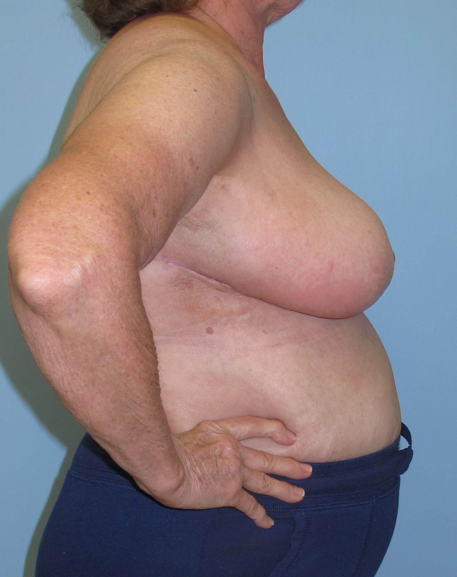 Breast Reduction After