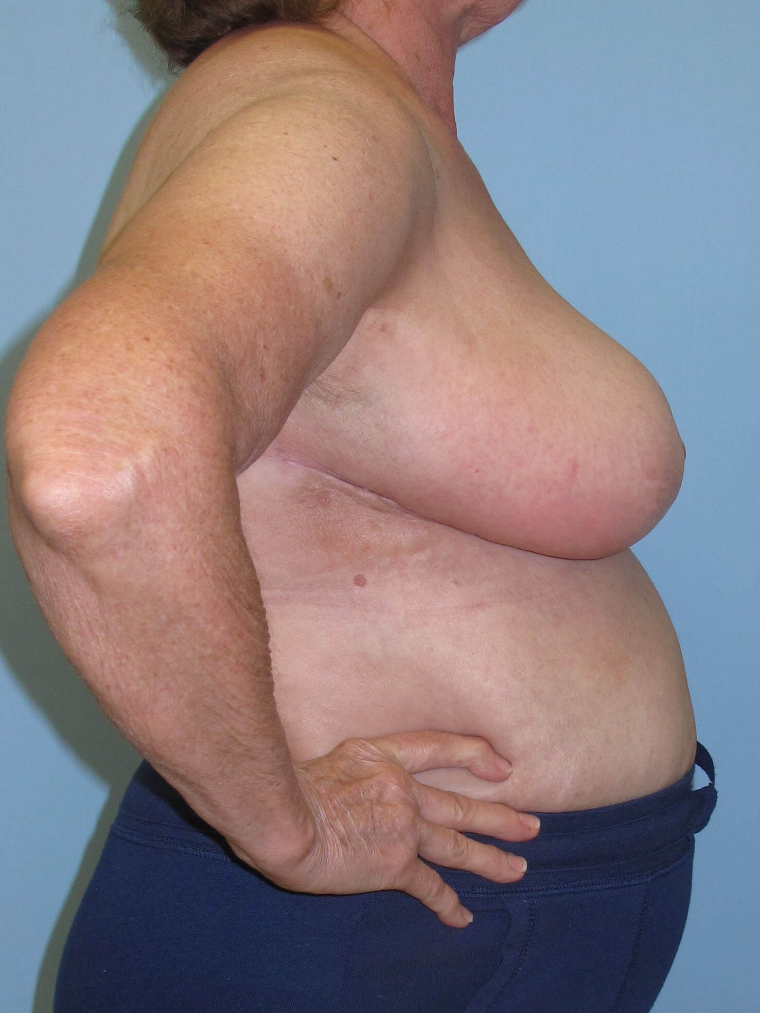 Breast Reduction After