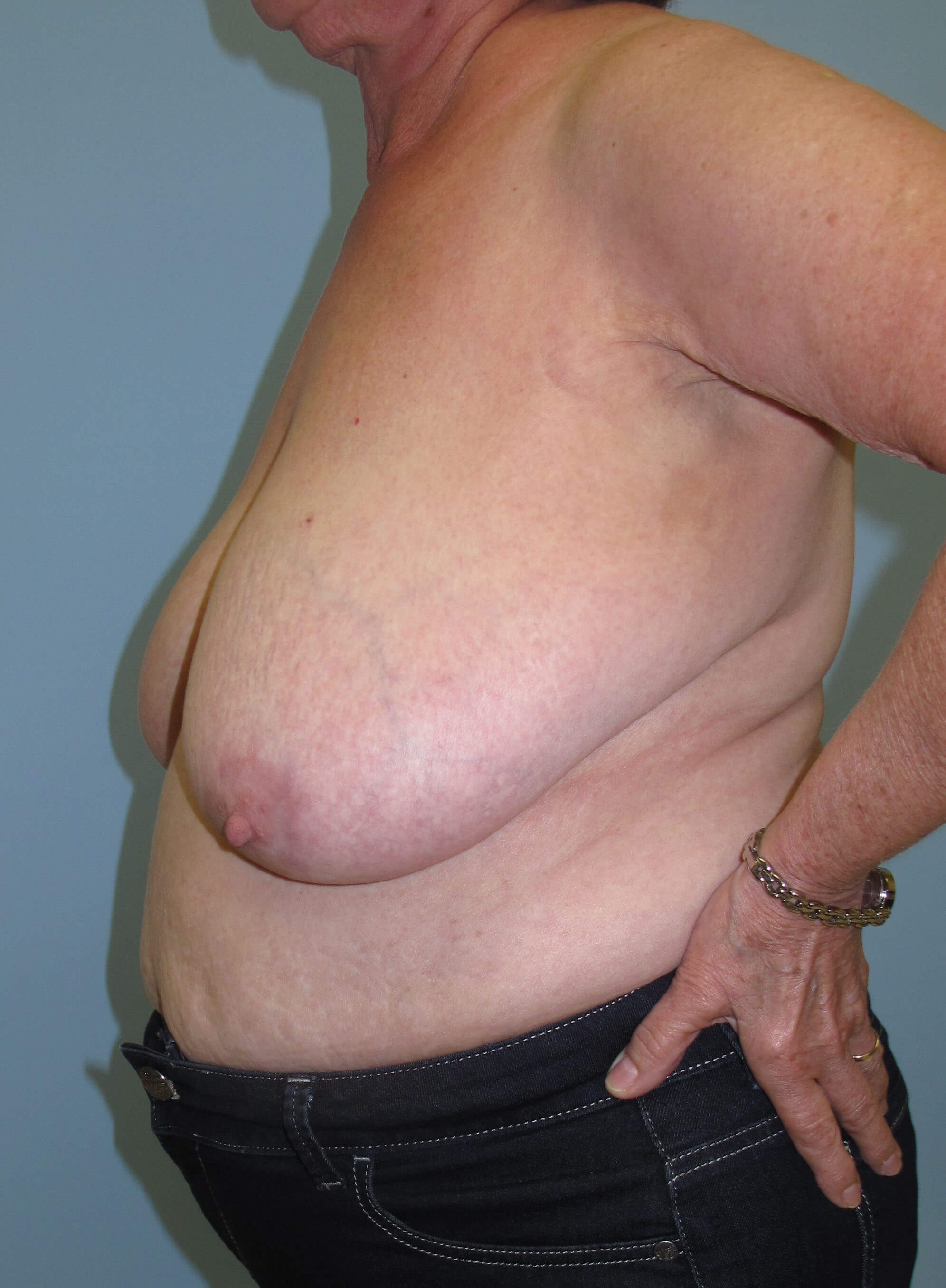 Breast Reduction Before