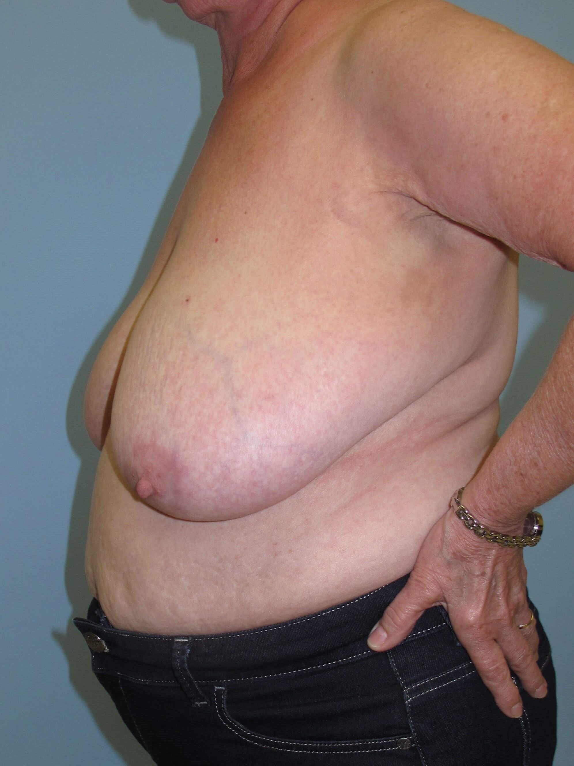 Breast Reduction Before