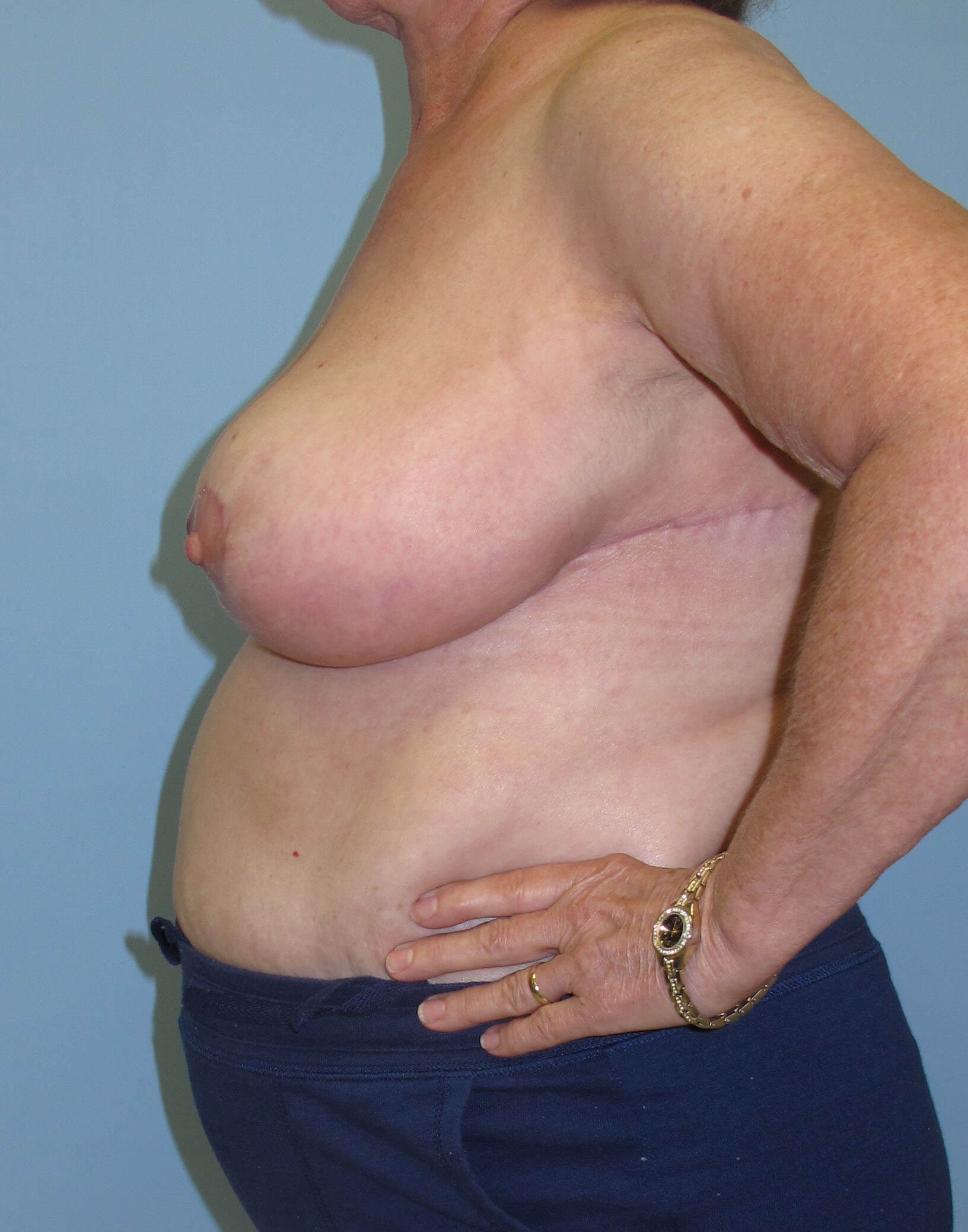Breast Reduction After