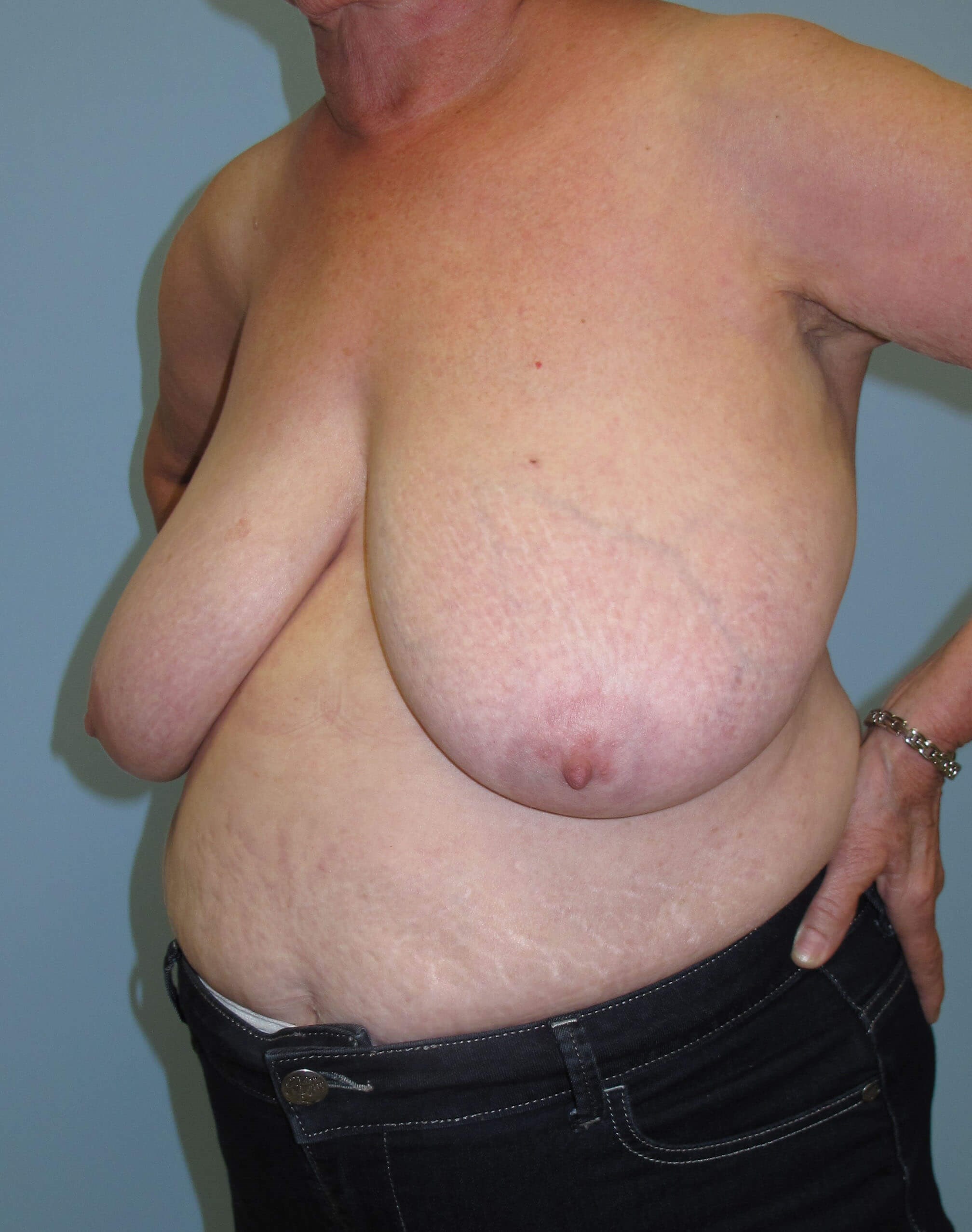 Breast Reduction Before