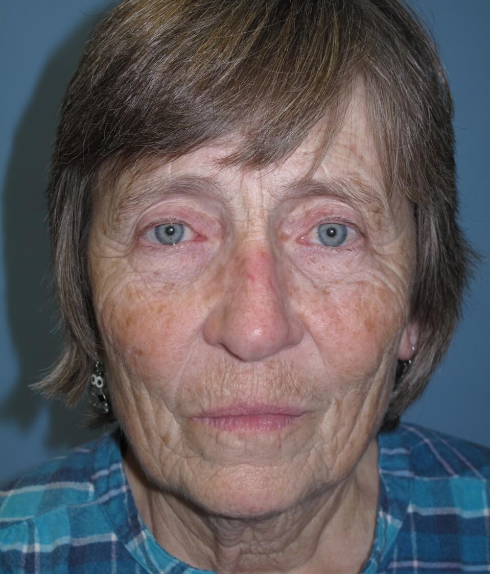 Blepharoplasty After